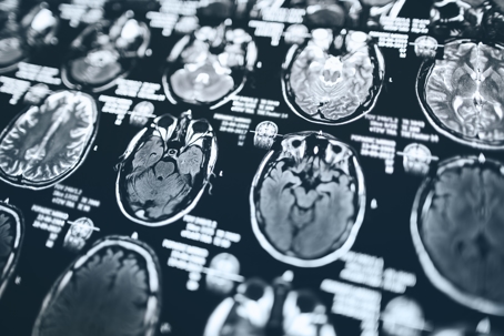 MRI